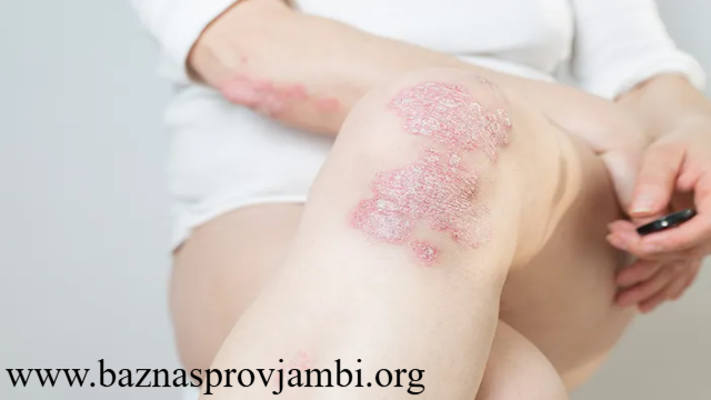 Tips Perawatan Kulit untuk Penderita Psoriasis